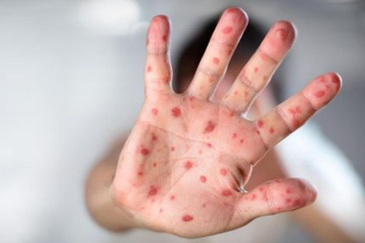 Viruela del mono ¿nuevo aviso de la naturaleza?